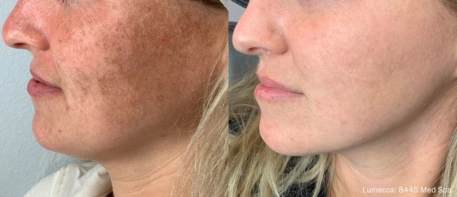 Lumecca IPL Treatment Before and After 1