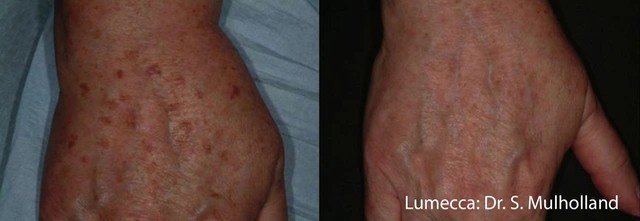 Lumecca Before and After 10