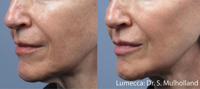 Lumecca Before and After 11