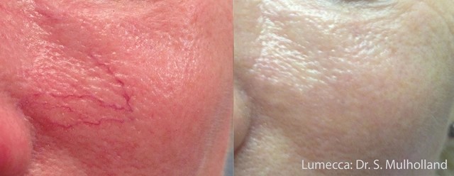 Lumecca Before and After 12