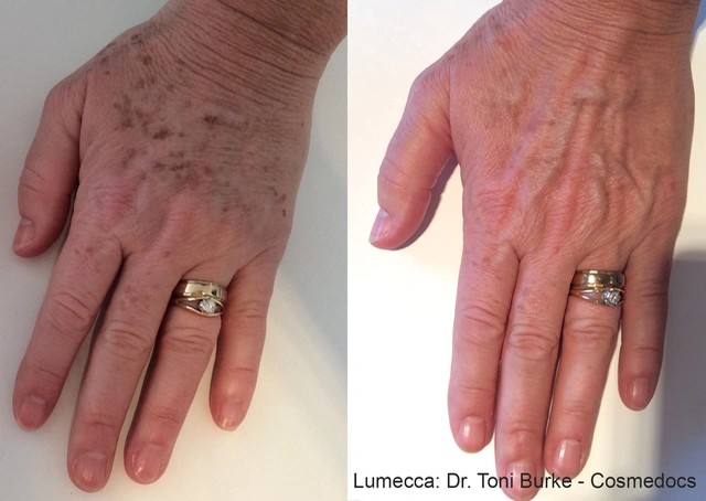 Lumecca Before and After 13