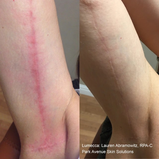 Lumecca Before and After 14
