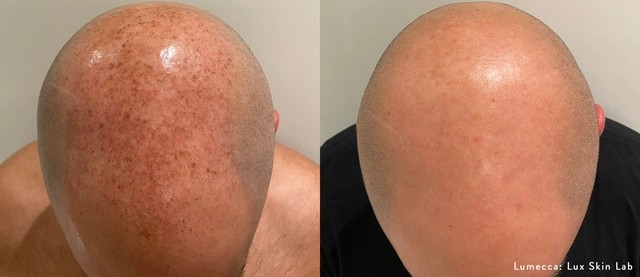Lumecca Before and After 15