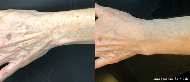 Lumecca Before and After 16