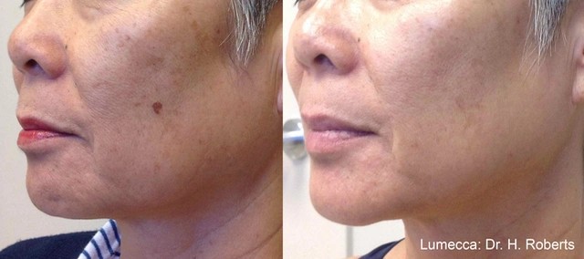 Lumecca IPL Treatment Before and After 2