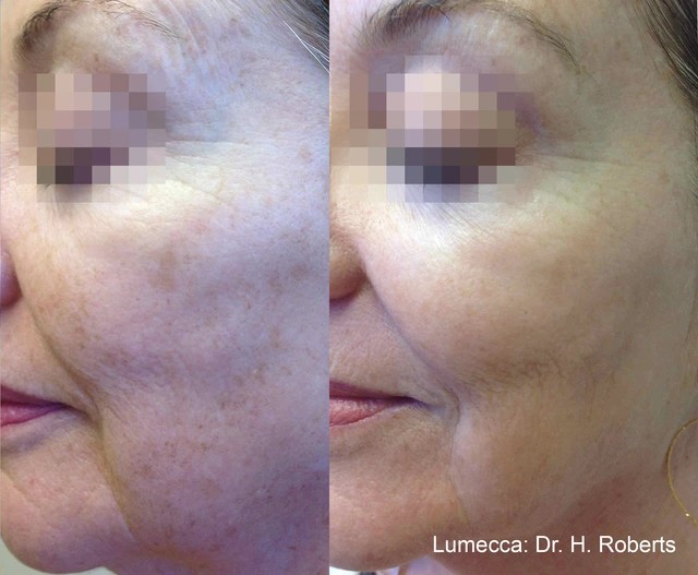 Lumecca IPL Treatment Before and After 3