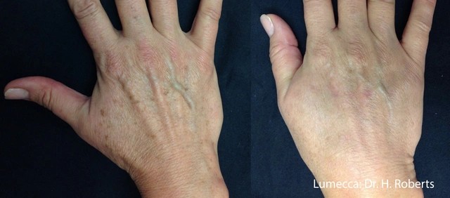 Lumecca IPL Treatment Before and After 4