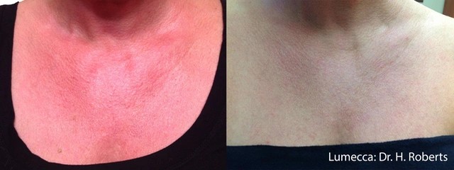 Lumecca IPL Therapy Before and After 5