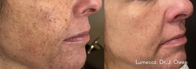 Lumecca IPL Procedure Before and After 6