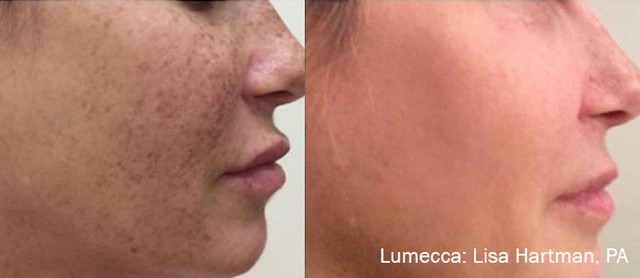 Lumecca IPL Treatment Results