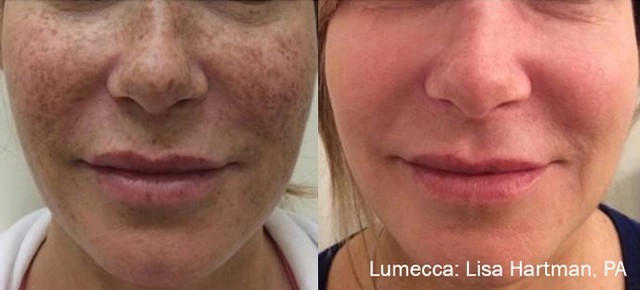 Lumecca IPL Therapy Results