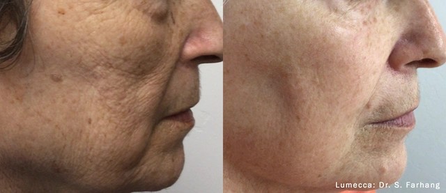 Lumecca IPL Procedure Results
