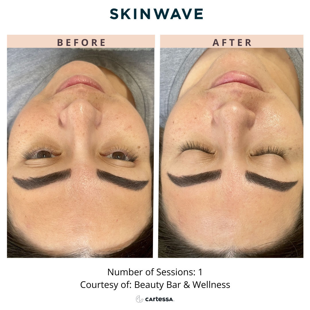 Before and After Skinwave Treatment in Wading River, NY