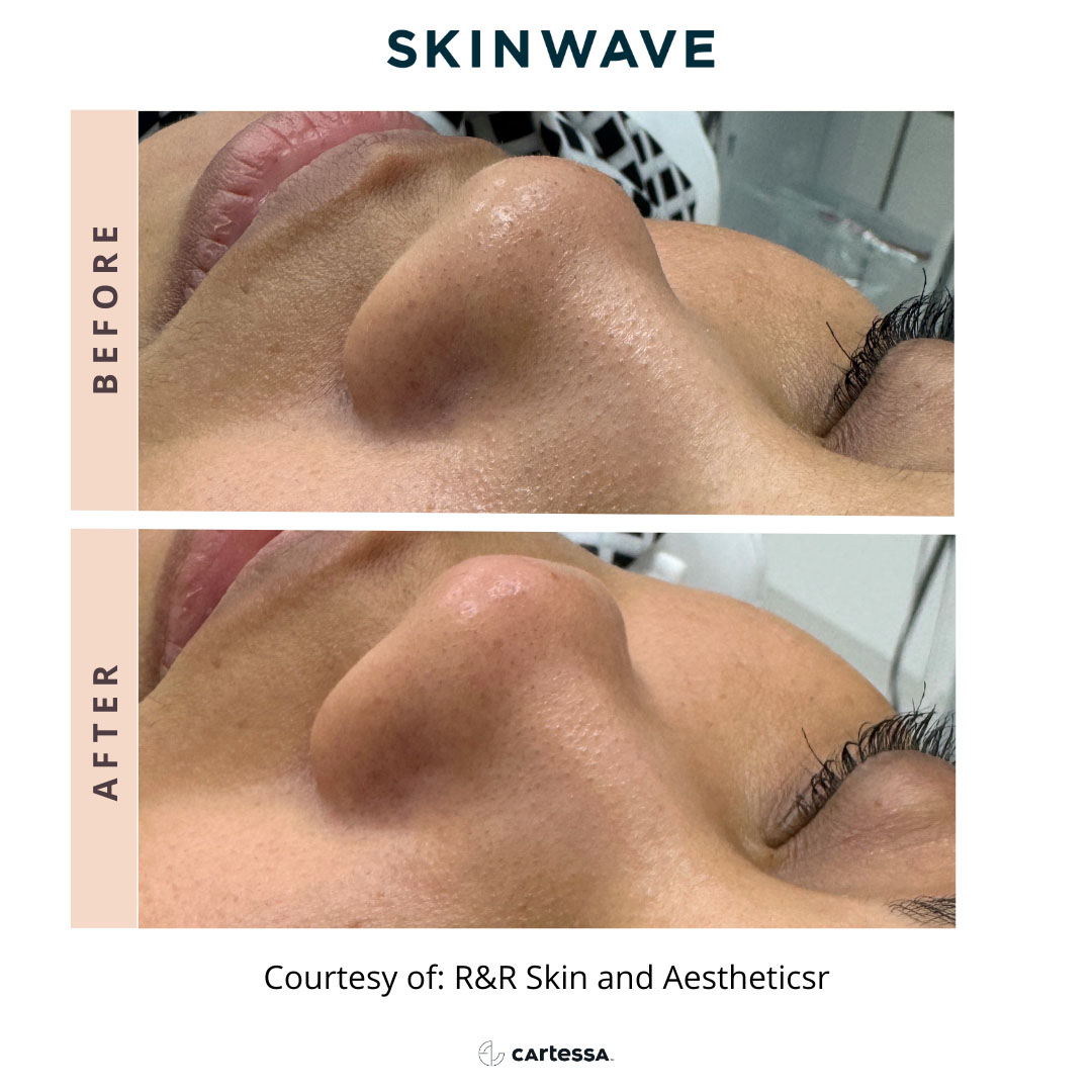 Before and After Skinwave Treatment in Wading River, NY